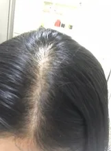 PURC-pulverizador para el crecimiento del cabello para hombres y mujeres, tratamiento para la pérdida de cabello de rápido crecimiento, productos de belleza para el cuidado del cabello, 30ml