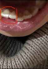 Eliminador de cálculo ultrasónico para el hogar, escarificador Dental eléctrico portátil, manchas de humo sónicas, placa de sarro, dientes blancos