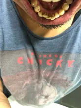 Eliminador de cálculo ultrasónico para el hogar, escarificador Dental eléctrico portátil, manchas de humo sónicas, placa de sarro, dientes blancos