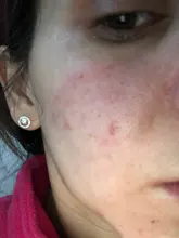 Aparato para limpieza profunda de la piel con espinillas, limpiador con punta de diamante de Zona T para nariz y resto del rostro, para la eliminación de espinillas, succión al vacío