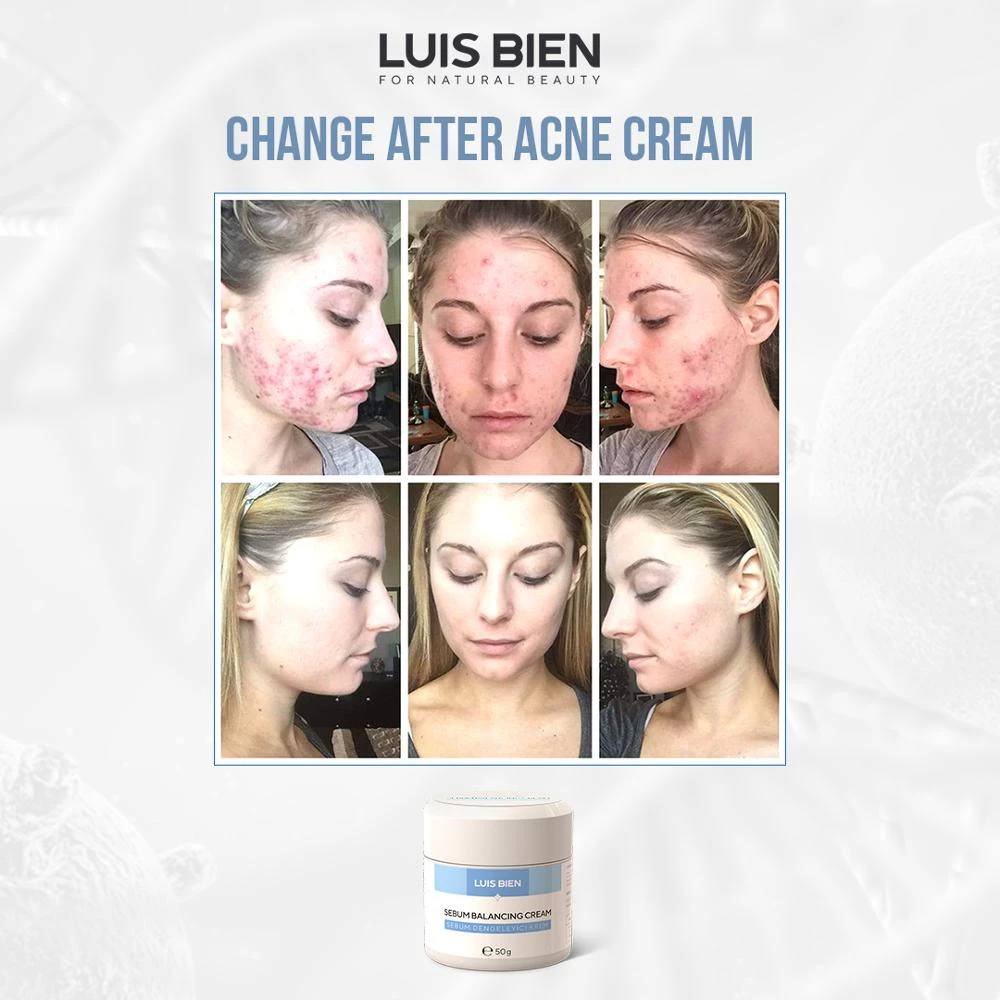 pimples from moisturizer