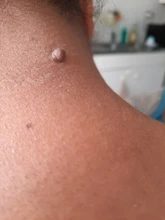 Juego de eliminador de verrugas y microetiquetas para la piel, Kit de limpieza con hisopo, topos y verrugas para adultos, cuidado facial, 1 Juego