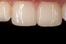 Fondo de ortodoncia Dental, tablero de contraste con imagen de la foto, placa de mejilla Oral con marca de escala, herramientas de dentista autoclavables, color negro, 6 uds.