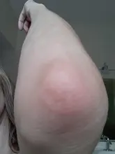 Dispositivos de fototerapia para Psoriasis en casa, lámpara de mano de banda estrecha para Vitiligo Eczema UVB 311NM, luz ultravioleta de Vitiligo de banda estrecha