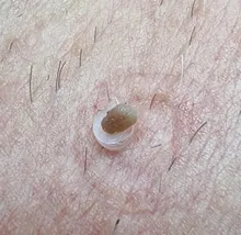 30 unids/caja de bandas de goma de la piel de alta calidad Etiqueta de eliminación de bandas de goma Micro banda no tóxico cuidado topo verruga cuidado de la piel