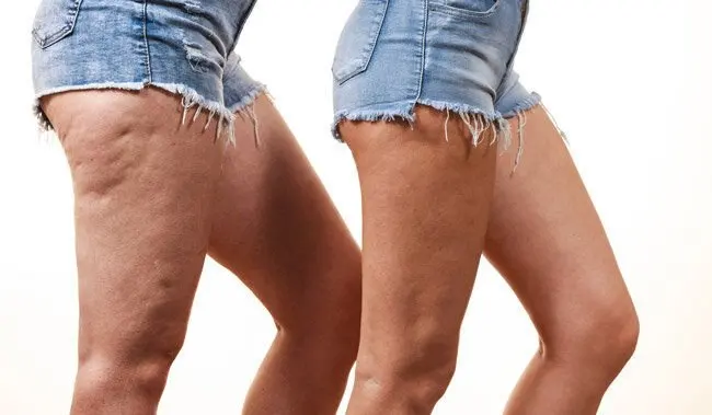 selulit-nedir-nasil-gecer