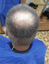 PURC-pulverizador para el crecimiento del cabello, tratamiento para la pérdida de cabello, para adelgazar, cuidado del cabello, 30ml