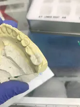 Kit de molde de impresión Dental Posterior, herramientas de llenado de restauración Dental