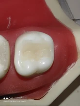 Kit de molde de impresión Dental Posterior, herramientas de llenado de restauración Dental