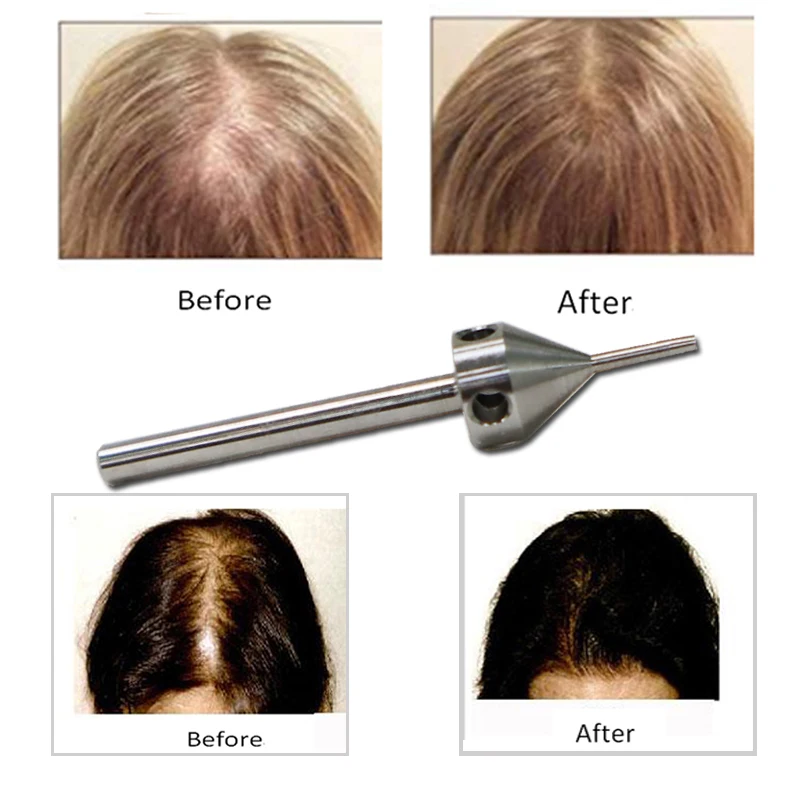 Hair Transplant Kit 1X Hair Transplant Implanter Kit FUE Manual Punch Size 0.8/0.9 mm for Hair Thinning and Balding Treatment-Make Thicker