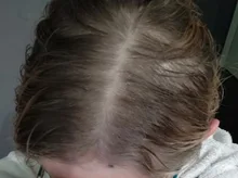 PURC-pulverizador para el crecimiento del cabello para hombres y mujeres, tratamiento para la pérdida de cabello de rápido crecimiento, productos de belleza para el cuidado del cabello, 30ml