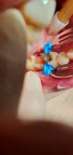 Pinzas de matriz contorneada seccional Dental, abrazaderas de Matrices, cuñas, herramientas de dentista, alicates tipo más nuevo A & B