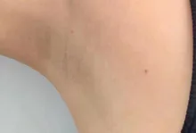 Máquina portátil de depilación, diodo láser de 808nm, Para rejuvenecimiento de la piel, máquina de depilación de 808nm, Envío Gratis