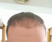 Aplicador de queratina para la pérdida del cabello, polvos de fibra de construcción para el crecimiento del cabello, Spray de estilismo, extensión de polvo de Color para adelgazamiento