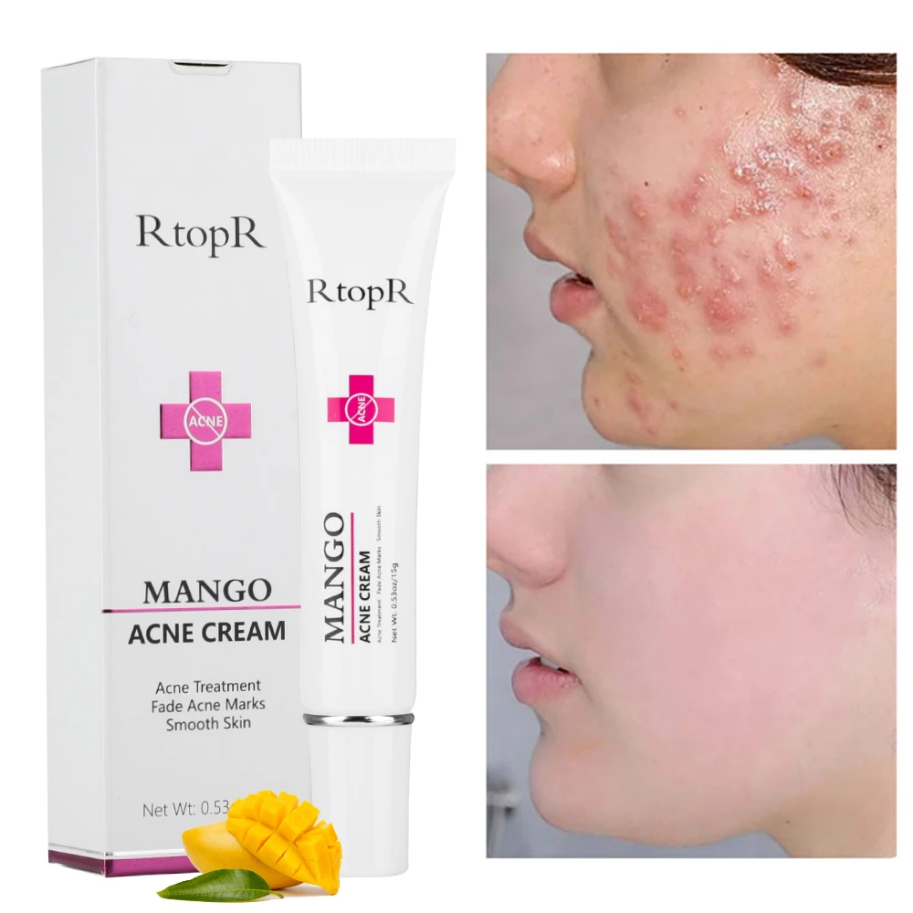 Pimple Face Cream ubicaciondepersonas.cdmx.gob.mx