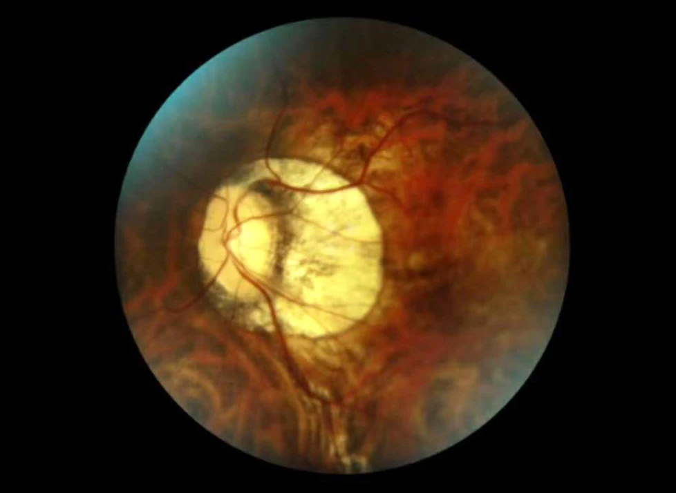 Портативная немидрическая сетчатая камера с камерой FDA для США|cameras camera|camera