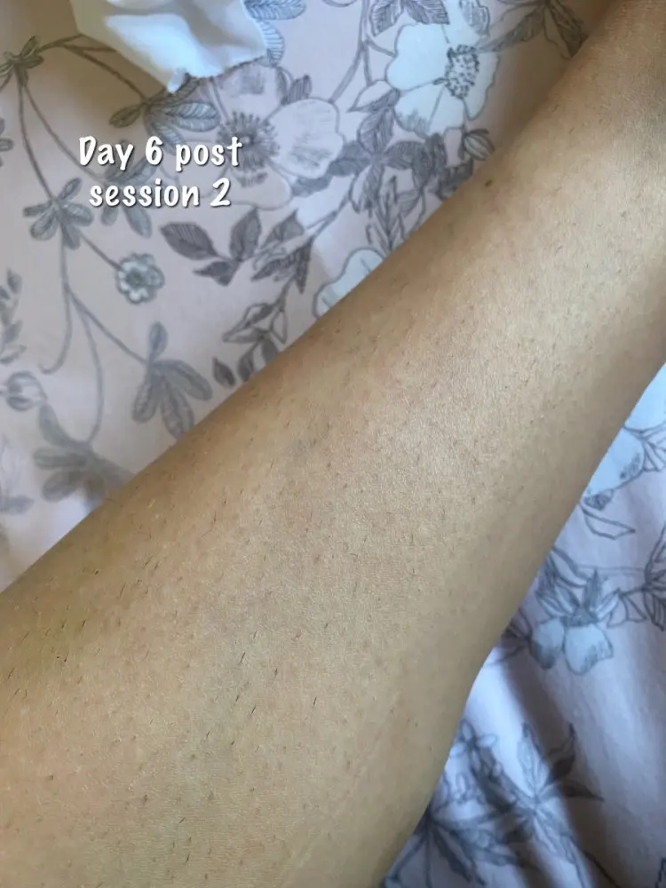 at home laser hair removal before and after KetchBeauty IPL Laser 