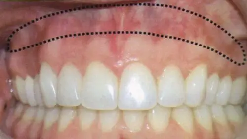 牙龈坏了的治疗方法以及应该如何修复牙龈-养生法典
