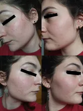 BREYLEE Anti acné reparación conjunto de máscara Facial tratamiento de eliminación de Control de aceite crema psiquiatra hidrata los poros para el cuidado de la piel suero