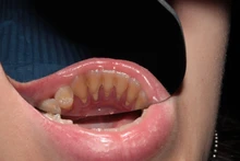 1 PC Dental ortodoncia doble espejos de dos lados Reflector odontología Intra Oral de vidrio recubierto de titanio Dental fotografía espejos