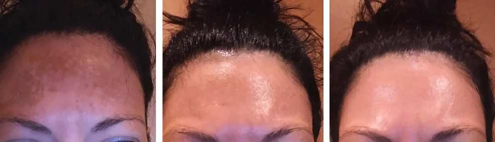 hydroquinone black skin