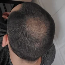 HAIRCUBE-esencia para el crecimiento del cabello, tratamiento para la pérdida del cabello, anticaída, prevención, Alopecia, líquido dañado, reparación del cabello