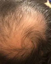 REAGAIN prevenir la pérdida de cabello productos para el crecimiento del cabello esencia crecer restauración