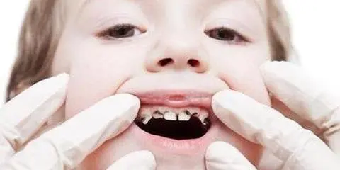 牙齿有黑斑的原因 怎样消除牙上的黑斑-养生法典
