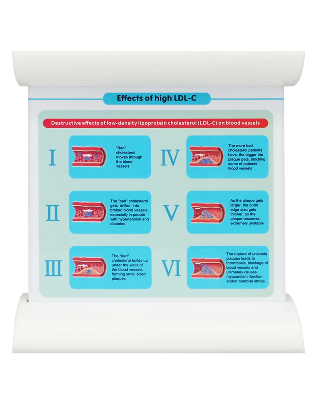 Anatomical Low-Density Lipoprotein LDL Blood Vessel Thrombosis Model Vascular Disease Pathology Demonstration Model