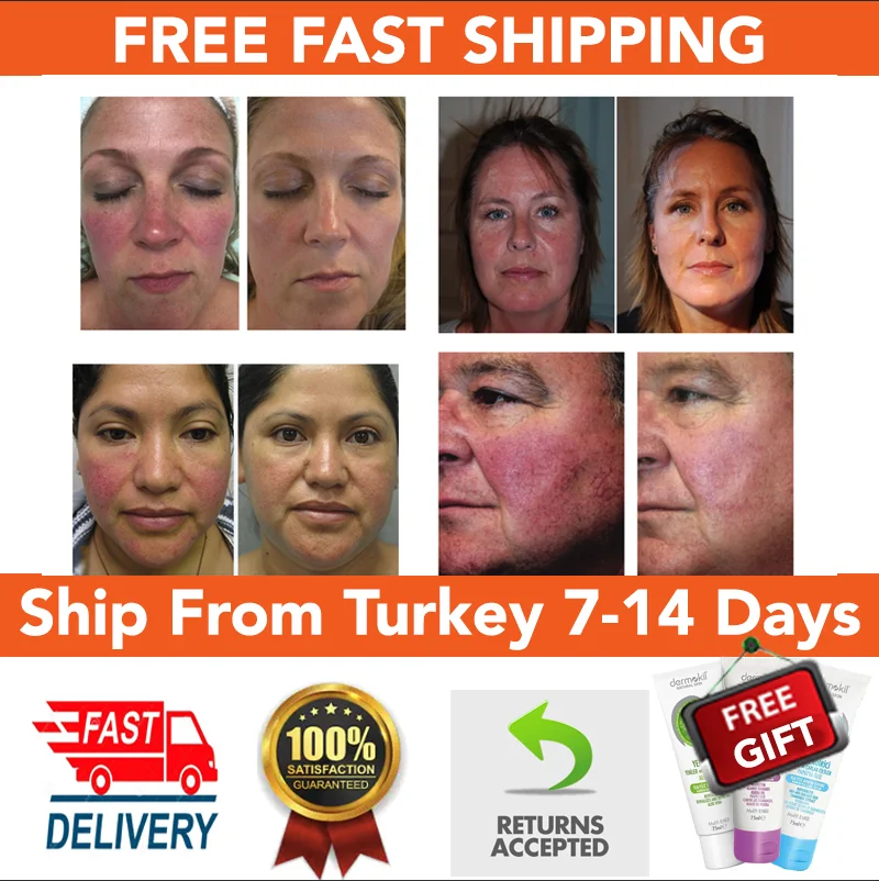 fucidin cream for rosacea