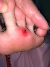 Parches médicos para el cuidado de los pies, almohadillas de eliminación de maíz, espinillas, parches curativos, elimina callosidades, desintoxicación, 30 Uds.