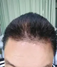 Dispositivos de fototerapia para Psoriasis en casa, lámpara de mano de banda estrecha para Vitiligo Eczema UVB 311NM, luz ultravioleta de Vitiligo de banda estrecha