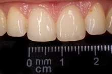 Fondo de ortodoncia Dental, tablero de contraste con imagen de la foto, placa de mejilla Oral con marca de escala, herramientas de dentista autoclavables, color negro, 6 uds.