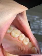 1 PC Dental ortodoncia doble espejos de dos lados Reflector odontología Intra Oral de vidrio recubierto de titanio Dental fotografía espejos