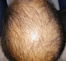 PURC-pulverizador para el crecimiento del cabello para hombres y mujeres, tratamiento para la pérdida de cabello de rápido crecimiento, productos de belleza para el cuidado del cabello, 30ml