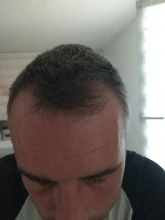 PURC-pulverizador para el crecimiento del cabello, tratamiento para la pérdida de cabello, para adelgazar, cuidado del cabello, 30ml