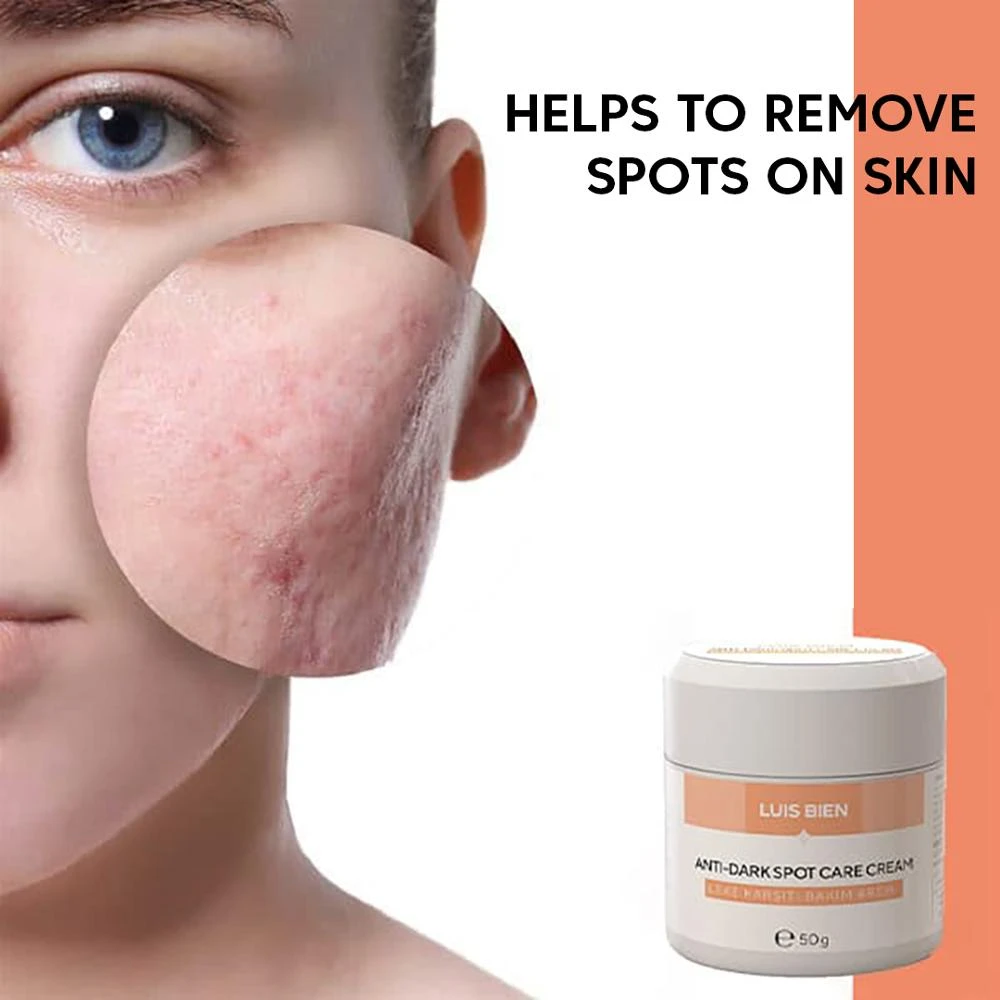 nose dark spot removal cream