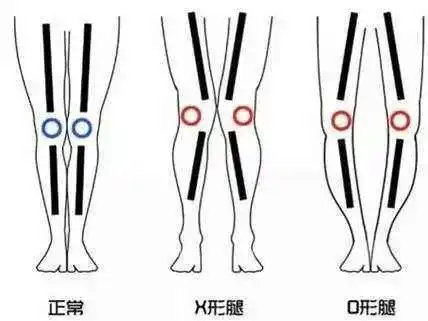 大腿腿型不直有哪些方法可以改善-养生法典