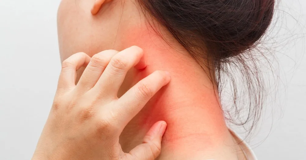 dermatite-da-contatto-ed-eczema-i-rimedi-naturali