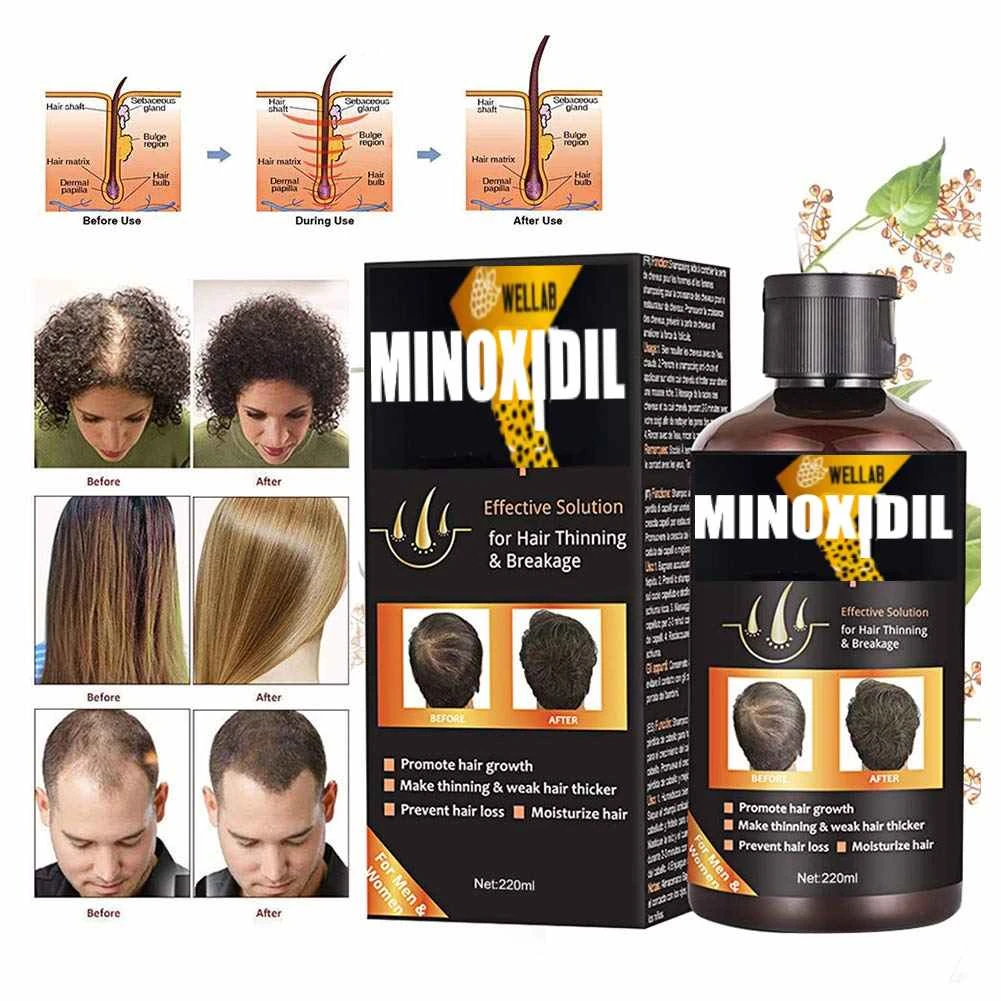 Minoxidil Shampoo
