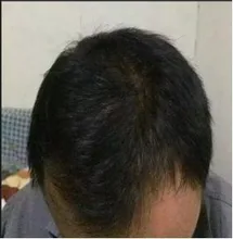 PURC-productos para el crecimiento del cabello para hombres y mujeres, aceite de crecimiento rápido, cuidado para la pérdida del cabello, tratamiento para el cuero cabelludo y el cabello, 30ml