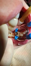 Pinzas de matriz contorneada seccional Dental, abrazaderas de Matrices, cuñas, herramientas de dentista, alicates tipo más nuevo A & B