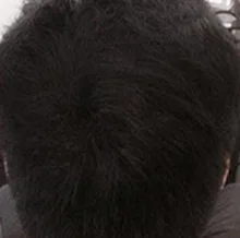 PURC-pulverizador para el crecimiento del cabello para hombres y mujeres, tratamiento para la pérdida de cabello de rápido crecimiento, productos de belleza para el cuidado del cabello, 30ml