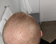 Suero para el crecimiento del cabello de jengibre, tratamiento para la pérdida del cabello con Spray, aceite esencial para el crecimiento del cabello Germinal efectivo en 7 días, cuidado del cabello para hombres y mujeres, 30ml