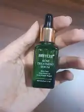BREYLEE-suero para el tratamiento del acné Facial, producto para el cuidado de la piel, eliminación de cicatrices, granos, blanqueamiento y acné