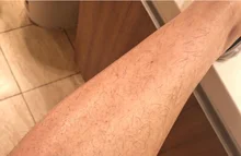 Máquina de depilación láser de diodo de alta energía, 808nm, Para rejuvenecimiento de la piel, 808nm, máquina de depilación indolora, envío gratis