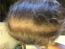 HAIRCUBE-esencia para el crecimiento del cabello, tratamiento para la pérdida del cabello, anticaída, prevención, Alopecia, líquido dañado, reparación del cabello