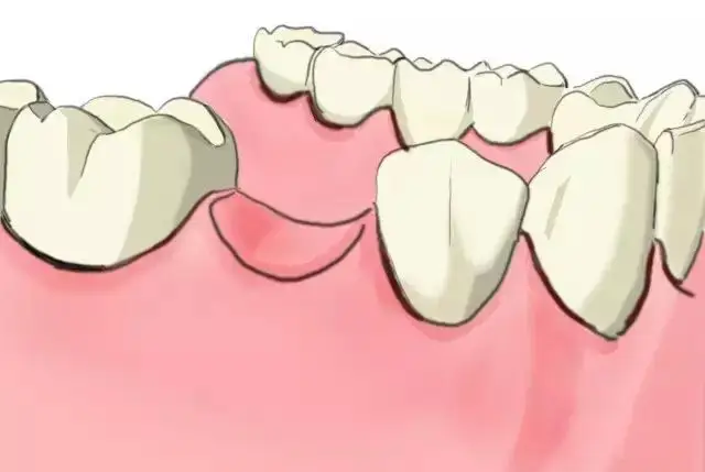 种牙需要注意的问题以及如何保护种牙-养生法典