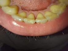 Eliminador de cálculo ultrasónico para el hogar, escarificador Dental eléctrico portátil, manchas de humo sónicas, placa de sarro, dientes blancos