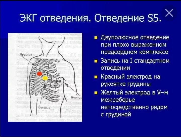 Экг по слопаку расположение электродов фото